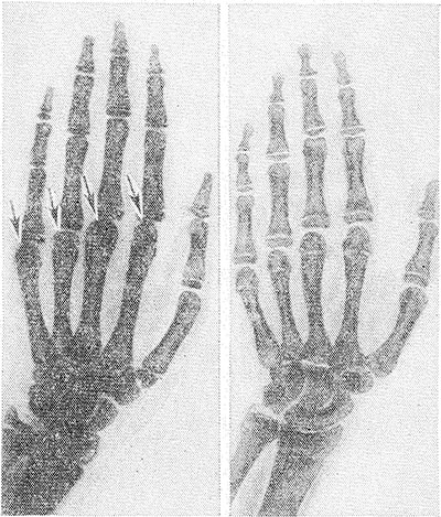 уровская болезнь