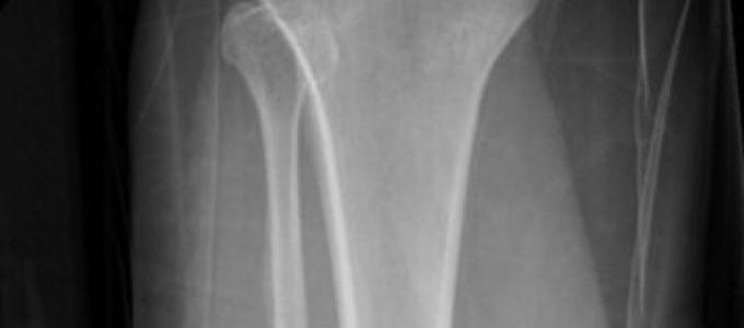 脛骨および腓骨の骨幹の骨折