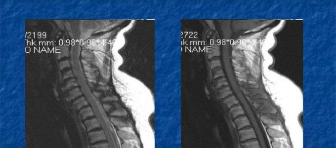 Síntomas de una fractura de la apófisis espinosa de las vértebras cervicales y primeros auxilios Fractura de las apófisis transversas de las vértebras lumbares