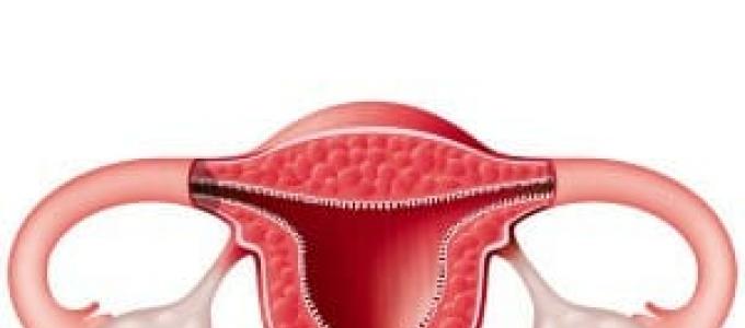 Why is the uterus not removed?  Uterus removal.  How to avoid it and when it is necessary.  Indications for hysterectomy